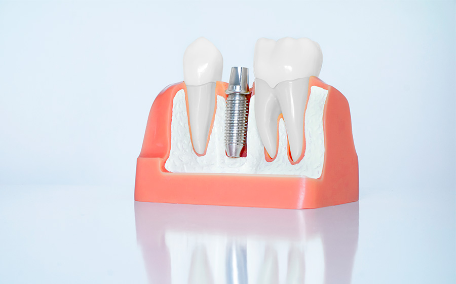 インプラント